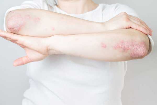 Breakthrough Treatments: Latest Medicines and Drugs for Psoriasis Relief