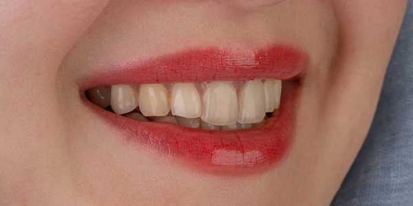 Acha que Limpeza de Dente é Cara? Veja Opções Acessíveis!